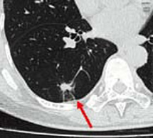 画像：CT検診で発見された肺がん