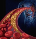[図]血流を妨げるコレステロール