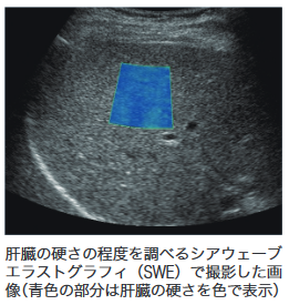 図：肝臓の硬さの程度を調べるシアウェーブエラストグラフィ（SWE）で撮影した画像（青色の部分は肝臓の硬さを色で表示）